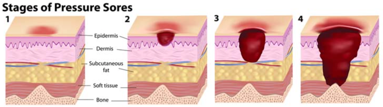 stages of pressure sores